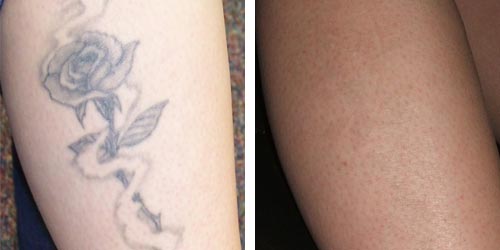 Behandling med RevLite - Tatueringsborttagning