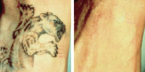 Behandling med RevLite - Tatueringsborttagning